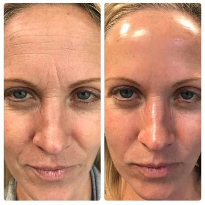 Retinal Shot –Efecto piel firme tipo lifting sin agujas