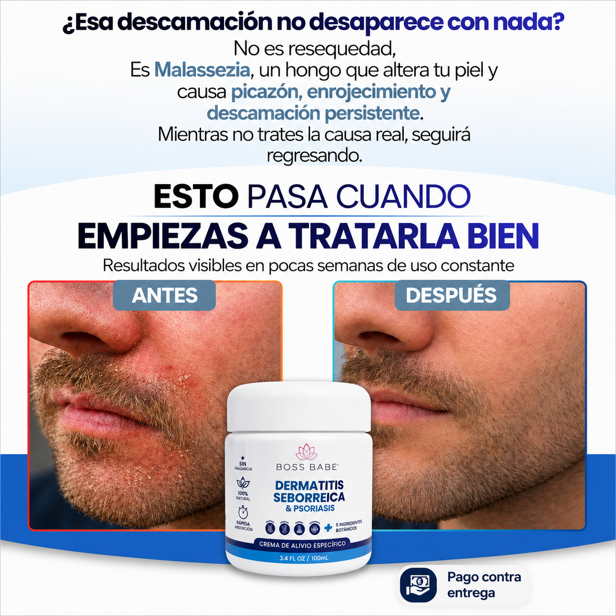 DERMATITIS SEBORREICA & PSORIASIS- Crema de Alivio Específico.