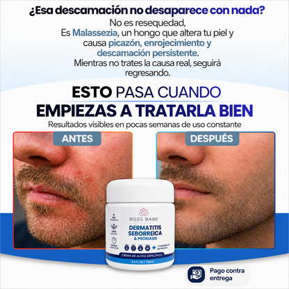 DERMATITIS SEBORREICA & PSORIASIS- Crema de Alivio Específico.